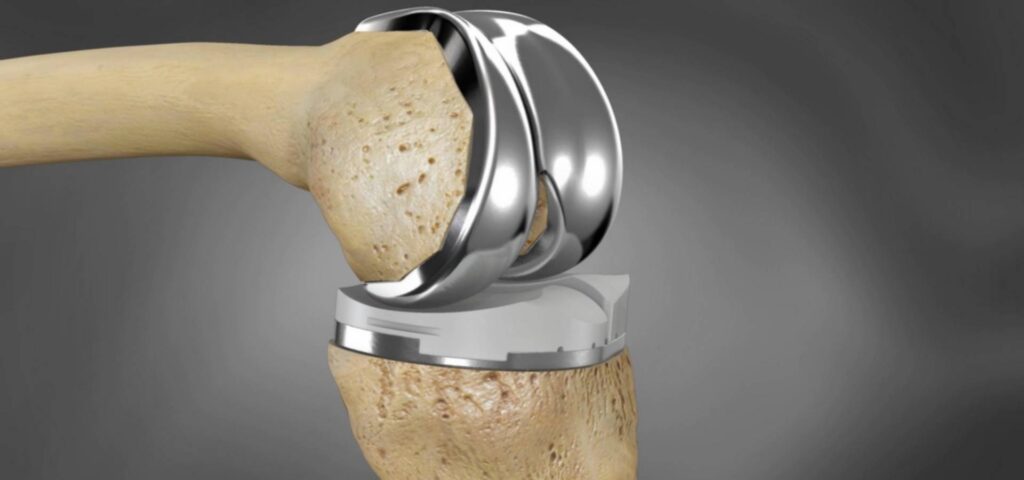 Prótesis de cadera y rodilla