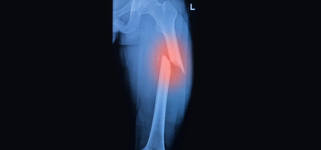 Cirugía de fracturas